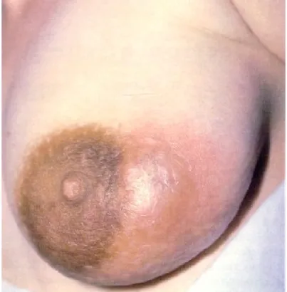 Gambar 2.5. abses 