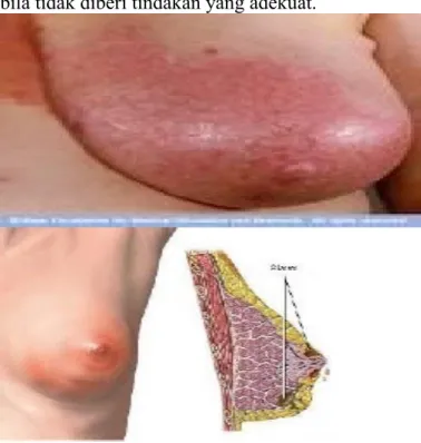 Gambar 2.2.Payudara yang mengalami mastitis