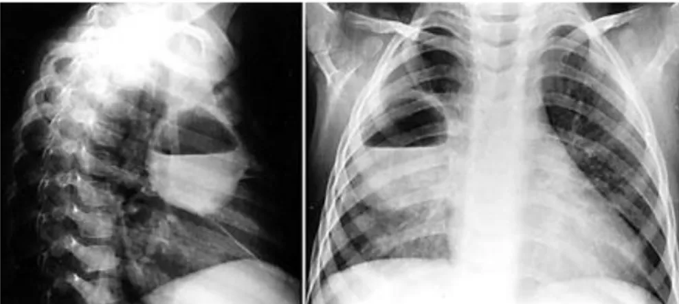 Gambar 4. Gambaran kavitas disertai air fluid level pada abses paru. Foto diambil  dalam posisi lateral(kiri) dan PA(kanan) 