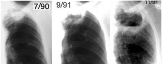 Gambar 7. Gambaran tuberculosis, terlihat proses terbentuknya kavitas. Kavitas  pada tuberculosis umumnya terletak di lapangan paru atas