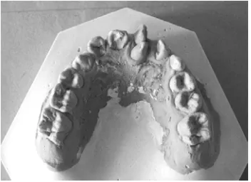 Figure 1. Study model of patient appears occlusal.