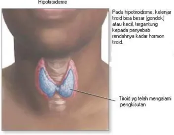 Gambar penderita hipotiroidisme dapat terlihat di bawah ini. 