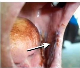 Gambar 3. Lesi lain yang dicurigai oral squamous cellcarcinoma.