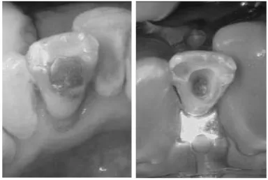 Gambar 1. Foto klinis dan radiograﬁ k gigi 31 sebelum perawatan.