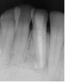 Gambar 6. Foto klinis gigi 31 sebelum dan setelah bleaching intra korona.