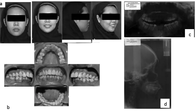 Figure 1. a. Extra oral, b. intra oral, c. panoramic and d. lateral cephalometry radiogram.