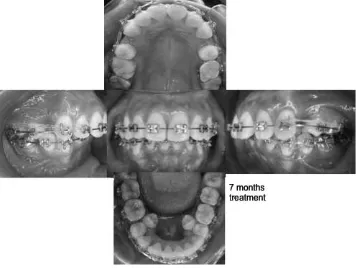 Figure 2. Intra oral feature on 3 months of treatment.