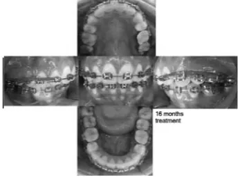 Figure 5. Intra oral feature on 13 months of treatment.