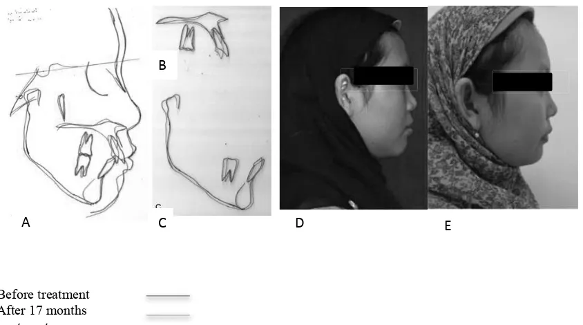 Figure 9. Lateral cephalometric radiogram superimposi� on on SN (A), on palatal plane (B), on lingual plate (C), so�  � ssue proﬁ le before (D) and a� er treatment (E).