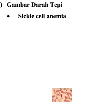 Gambar 1. Bentuk sel sabit eritrosit yang abnormalGambar 1. Bentuk sel sabit eritrosit yang abnormal 66