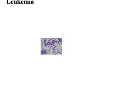 Gambar  3. Abnormalitas Abnormalitas (bizzare) (bizzare)  sel  darah  merah,  poikilositosis   sel  darah  merah,  poikilositosis (bentuk  eritrosit  bermacam-macam)  berat,  hipokromi  (eritosit  tampak(bentuk  eritrosit  bermacam-macam)  berat,  hipokrom