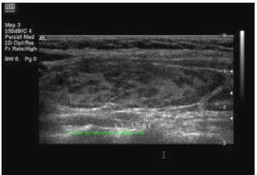 Gambar Hashimato Thyroiditis
