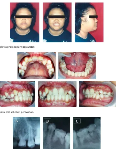 Gambar 2. Foto intra oral sebelum perawatan.