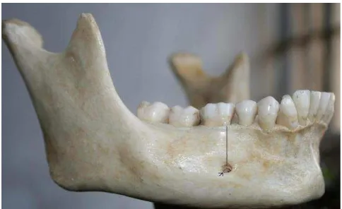 Gambar 1. Gambaran foramen mentale.7 