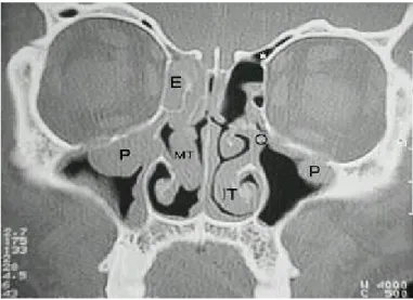 Gambar 14. CT Scan memperlihatkan penebalan mukosa sinus. 