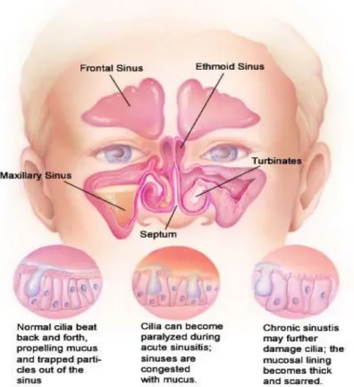 Gambar 4. Perubahan silia pada sinusitis