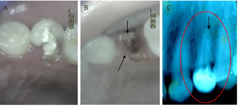 Gambar 1. Keadaan gigi sebelum perawatan. A) Gigi dengan restorasi resin komposit dan tumpatan sementara; B) Setelah penyingkiran resin komposit dan tumparan sementara; C) Gambaran radiografi, terlihat adanya lesi periapikal (panah).