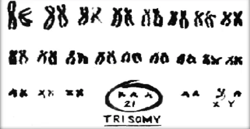 Gambar 1. Karyotype individu dengan trisomi 2110 