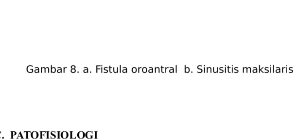 Gambar 8. a. Fistula oroantral  b. Sinusitis maksilaris