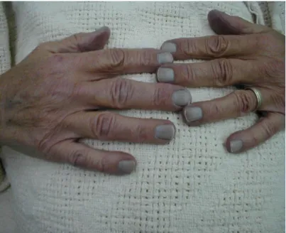 Gambar Splinter Hemmorrhages 