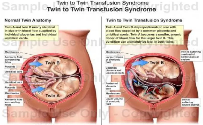 Gambar 8. Perbandingan kehamilan gemelli normal dan TTTS