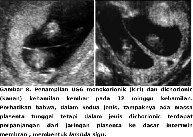 Gambar   8.   Penampilan   USG   monokorionik   (kiri)   dan   dichorionic (kanan)   kehamilan   kembar   pada   12   minggu   kehamilan.