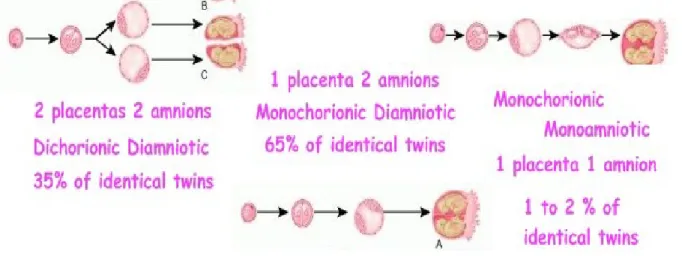 Gambar 2. jenis-jenis kembar monozigot