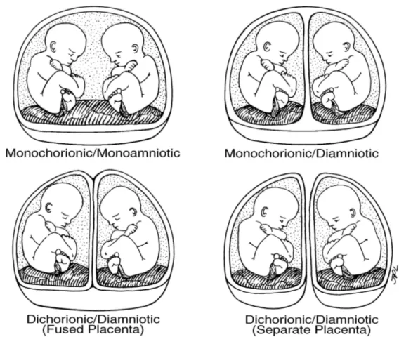 Gambar 4. Plasenta dan selaput janin kembar monozigot 2. Kehamilan Kembar Dizigot