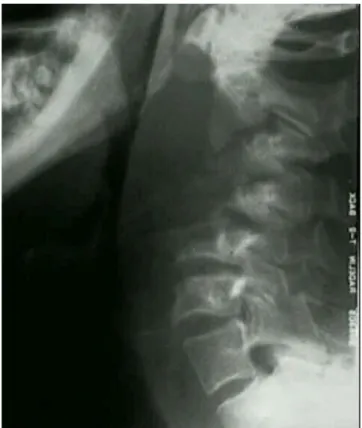 Gambar 4. Gambaran Foto Polos Spondilitis Tuberkulosis.