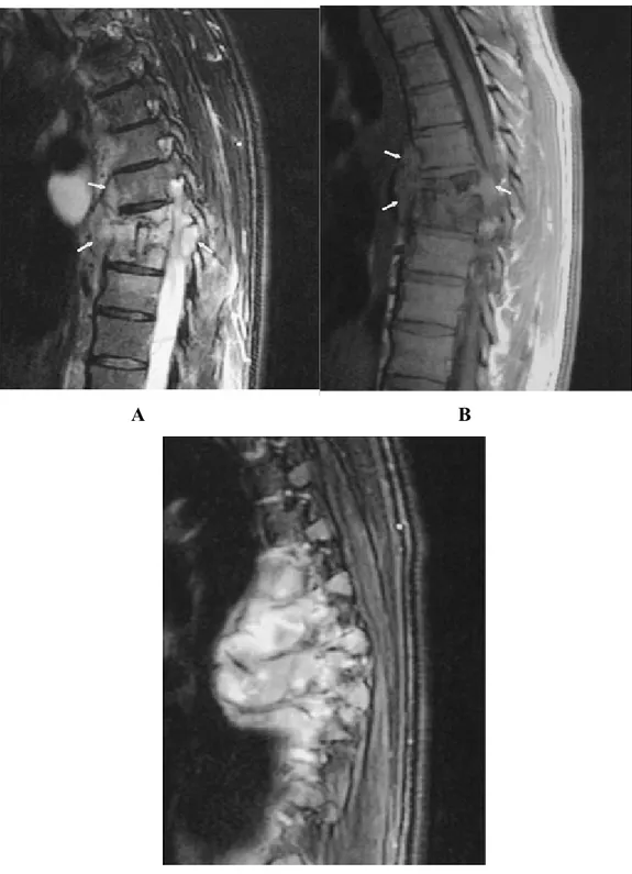 Gambar 7. MRI Spondilitis Tuberkulosis. A dan B gambaran potongan sagital dari vertebra thorakal,  menunjukkan gambar disk space loss dan kompresi vertebral dengan ekstensi jaringan lunak paravertebral (panah).