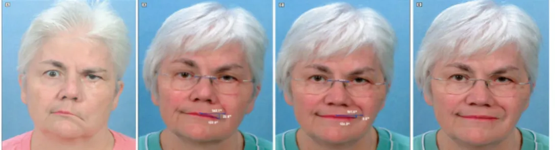 Gambar 2. Visualisasi Pola Senyuman Pasien Pra dan Pasca Operasi [2]. 