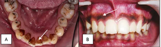Gambar 3. Dampak kebiasaan merokok pada rongga mulut. (A) Dental 27 