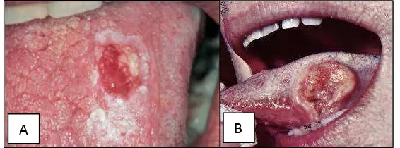 Gambar 6. Kanker rongga mulut. (A) Tahap awal pertumbuhan kanker pada lidah, (B) Perkembangan   lebih lanjut dari kanker rongga mulut27 