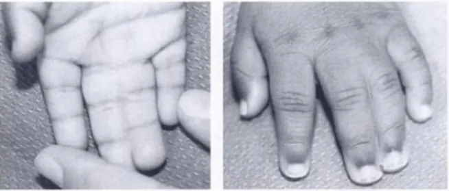 Gambar 1 Sindaktili