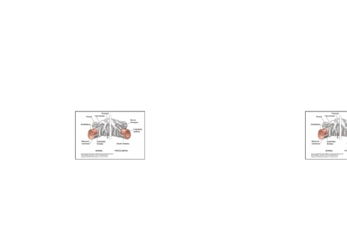 Gambar 2.1. Perbedaan endothel pada vaskular normal dan preeklampsia