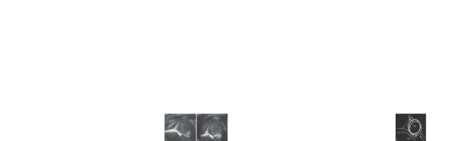 Gambar 7. USG coronal meperlihatkan caput femur yang bulat berada pada  USG coronal meperlihatkan caput femur yang bulat berada pada posisi sentral posisi sentral ((FH FH –   – femoral head, YCfemoral head, YC  –   – Y-cartilage, L- labrum)Y-cartilage, L- 