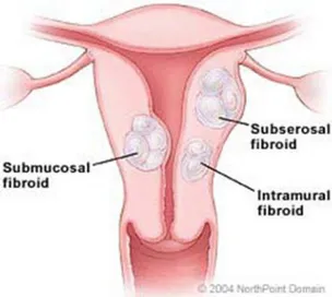 Gambar 1 : jenis-jenis mioma uteri 