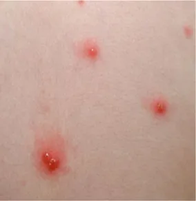 Gambar 5.1 Gambaran ruam pada infeksi virus varicella zoster Sumber : http://health.howstuff works.com