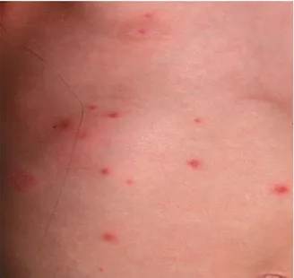 Gambar 5.2 Infeksi varicella pada penderita dengan imunisasi Sumber : http://www.emedicinehealth.com