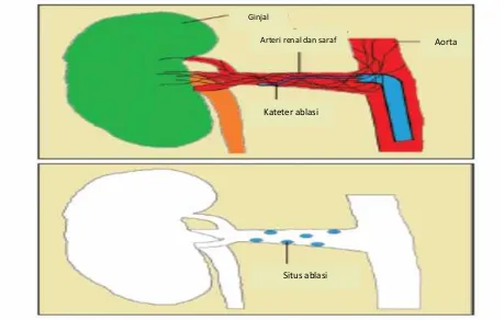 Gambar 5. Ilustrasi skematik mekanisme denervasi simpatik ginjal dalammenurunkan tekanan darah