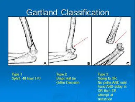 Gambar 2.6 Kalsifikasi Gartland Klasifikasi (Gartland):