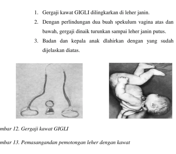 Gambar 12. Gergaji kawat GIGLI 