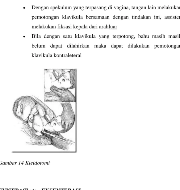 Gambar 14 Kleidotomi 