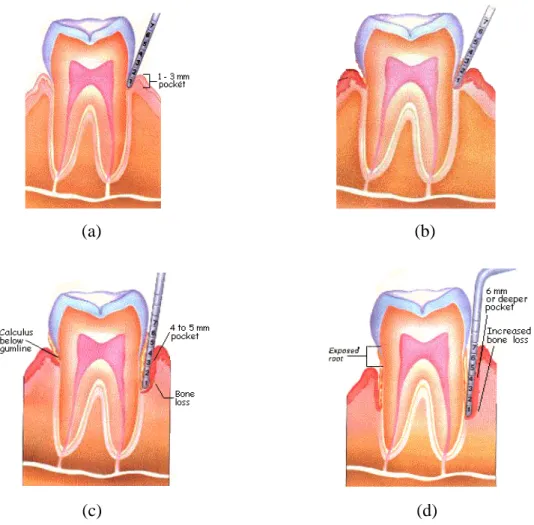 Gambar 1. Tahapan penyakit periodontal : (a) batas gingiva normal            (b) periodontal I / gingivitis (c) periodontitis II  (d) periodontitis III 