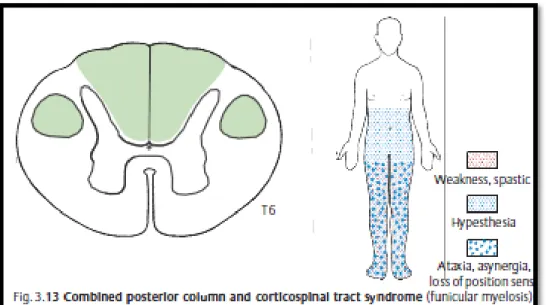 Gambar 9 : Sindrom kombinasi kolumna posterior dan kortikospinalis (dikutip dari  kepustakaan 2) 