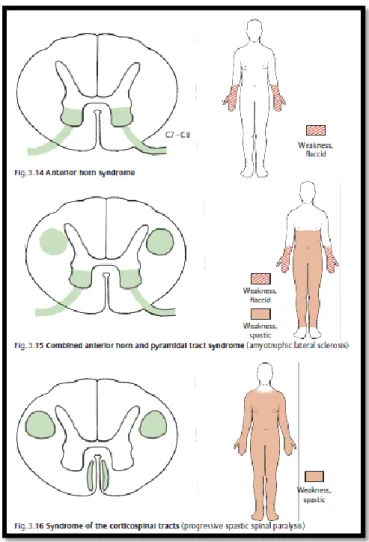 Gambar 10 : Sindrom traktus kortikospinalis (dikutip dari kepustakaan 2) 