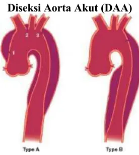 Gambar 2.1 Diseksi Aorta Akut