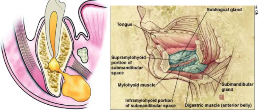 Gambar ilustrasi abses submasseter