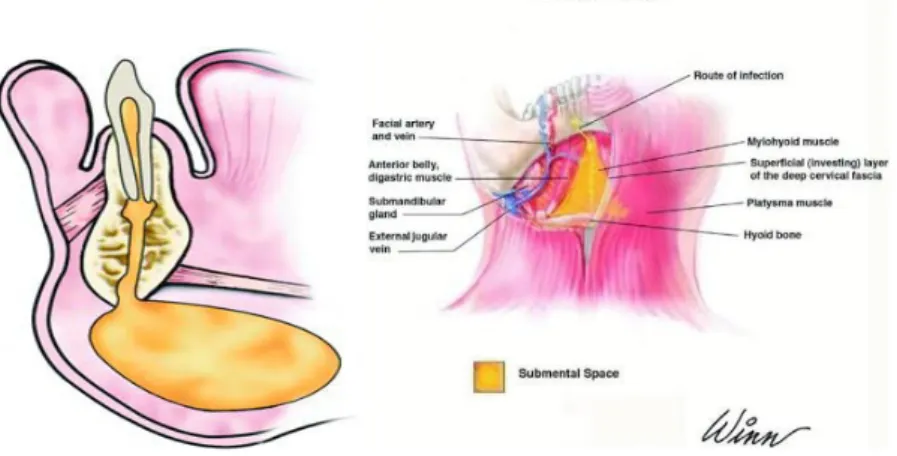 Gambar ilustrasi abses sublingual