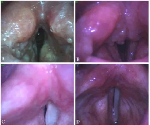Gambar 5. Temuan Laringoskopi pada Laringitis Tuberkulosis, A. Lesi Ulseratif (pada seluruh laring), B